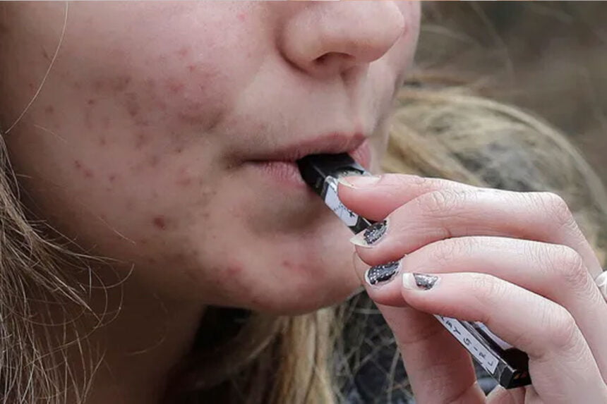 does vaping cause acne