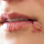 Can You Get Herpes from Sharing a Vape