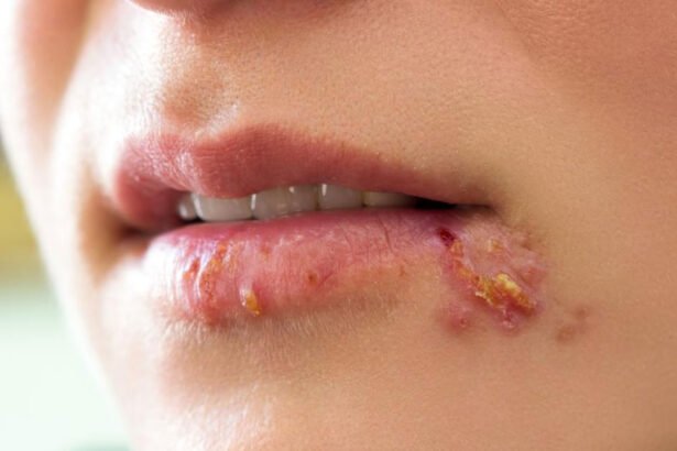 Can You Get Herpes from Sharing a Vape