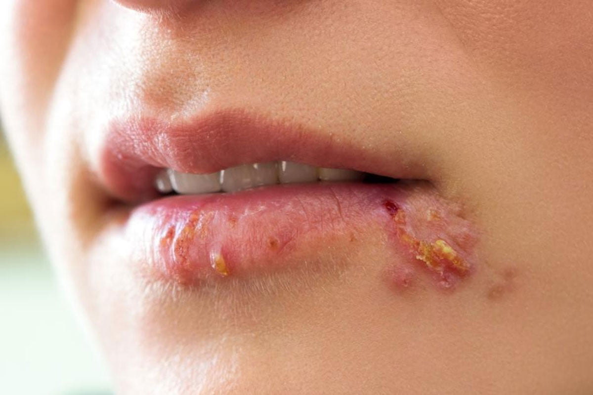 Herpes Transmitted Through Kissing Can You Get Herpes From Sharing A Vape?  Expert Safety Tips How Long Does